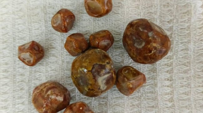 В Саратовской области у подростка удалили десять крупных камней - «Семья»